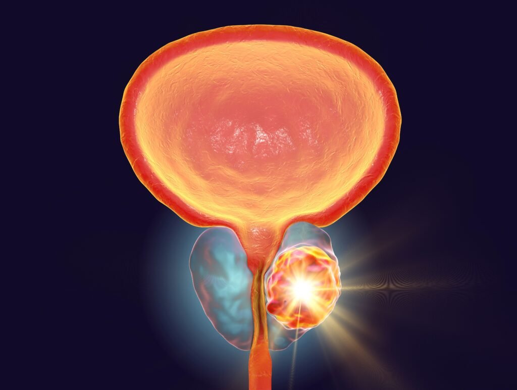 Disability Status Linked With Lower Prostate Cancer Screening Rates