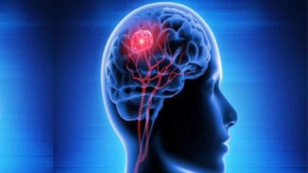 DNA damage could be causing Huntington’s disease. Study opens door to a new way to treat