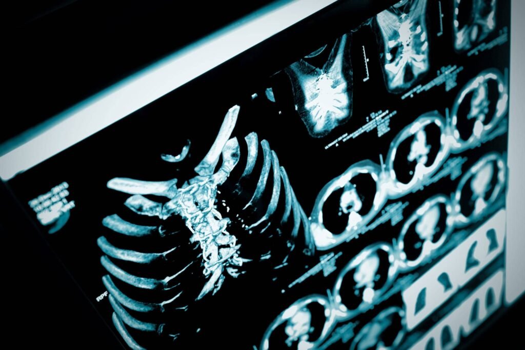 Novel Surgical Approach Streamlines Lung Cancer Care
